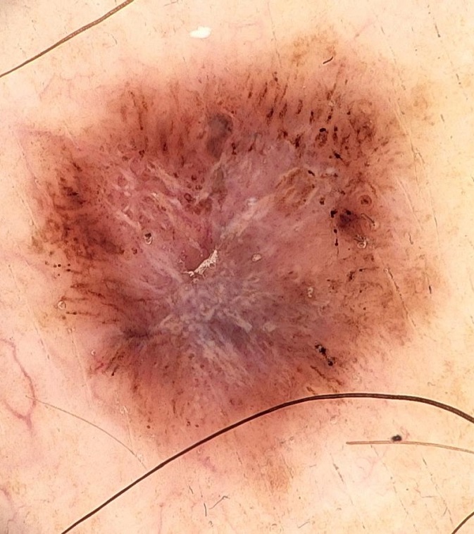 Full Body Mole Mapping