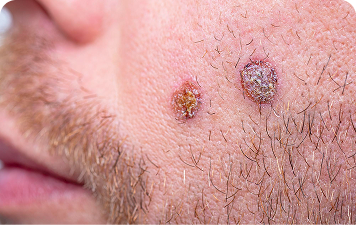Basal Cell Carcinoma