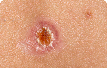 Squamous Cell Carcinoma